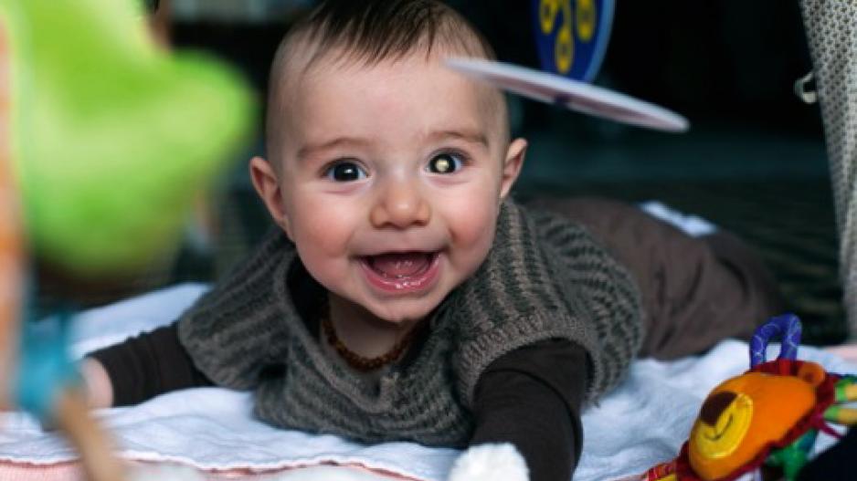 Kinder-Augen-Krebs-Stiftung zeigt erkranktes Baby mit dem typischen weißen Fleck im Auge.